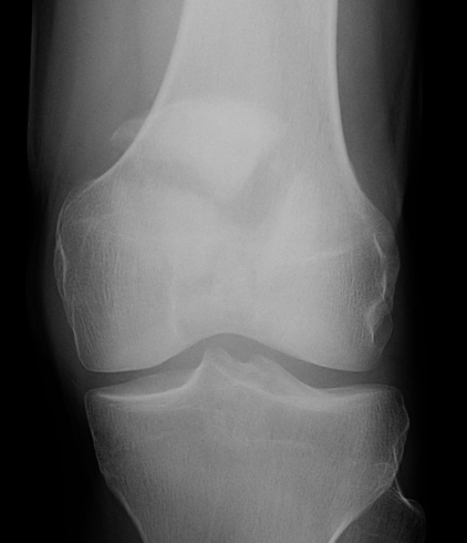 Patella Fracture Stellate